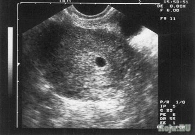 Как Выглядит 5 Недель Беременности Фото