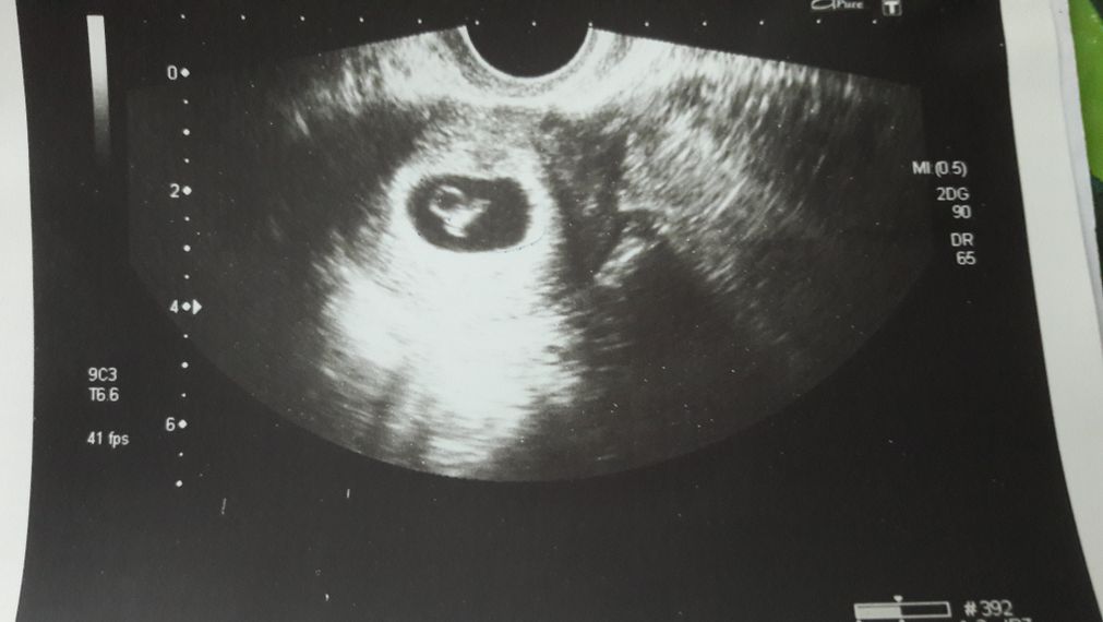 Снимок узи беременности 8 недель фото