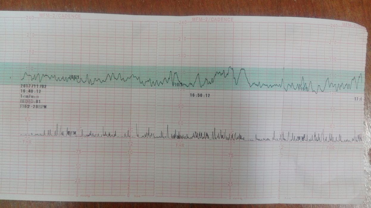 Кто понимает в графике КТГ?! Посмотрите
