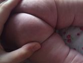 Прыщи на попе