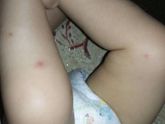 Прыщики на ножках