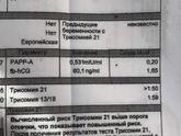 Синдром Дауна