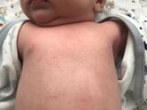 Sos! Сыпь у месячного малыша
