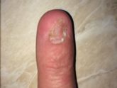 Грибок ногтя