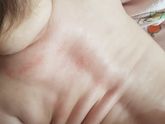 Аллергия/потничка