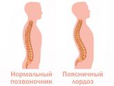 Гиперлордоз
