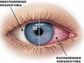 Красный глазик у грудничка