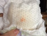 Девочки Хелп и сос!!! грудничок 2 месяца, кровь на памперсе