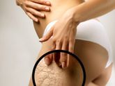 Растяжки , народные средства !!! Проверенные способы !