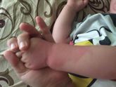 Девочки,месяц назад получили ожог.