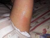 Покраснение на ляшках и чуть чуть на попке