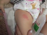 Реакция после инфантрикс