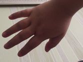 Отеки