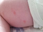 Если у кого-то такое было, скажите что это и как лечили
