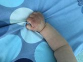 Аллергия на укусы насекомых