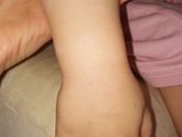 Аллергия или потница!?