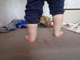 Вопрос для мам, у кого у деток был вальгус.
