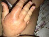 Аллергия на укусы насекомых