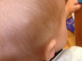 Фиброма на голове у ребенка