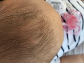 Шелушиться кожа на голове