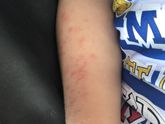Аллергия или потница? Чем лечить?