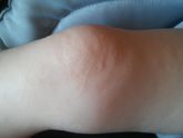 Сыпь.У кого было подобное?