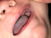 Белая шишечка на десне😱