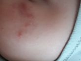 А-DERMA