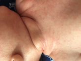 Девочки ребёнка обсыпало всего