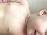 Сыпь на теле у ребенка