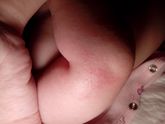 Аллергия или раздражение?