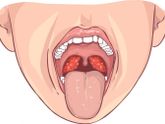 Тонзиллит👄👅
