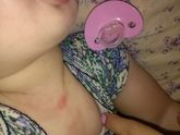 Сыпь