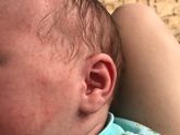 Цветение, потничка или аллергия?