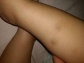 Не понятные прыщи у ребенка