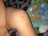 Прыщ у сына на ноге