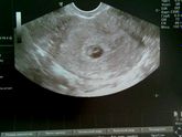 Если есть желточный мешочек, то и эмбрион появится?