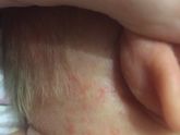 Сыпь на лице. Аллергия или акне новорожденных?