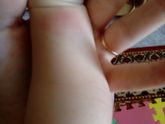 Укус комара