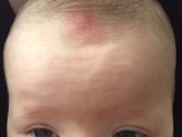 Прыщ или покраснение в области родничка