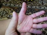 Пятнышки на ладошках