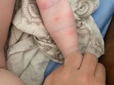 Ребёнка покусали комары..