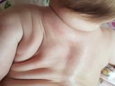 Аллергия/потничка
