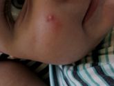 Help! Прыщ