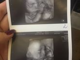 Узи 24,4 недели, двойняшки👶🏻👶🏻❤️
