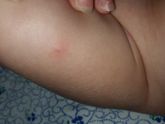 Нам вчера поставили прививки