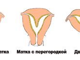 Двурогая матка с нефункционирующим левым рогом (однорогая матка). ЭКО.