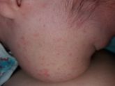 Акне новорожденного или аллергия?