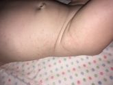 Потничка или аллергическая реакция?