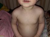 У дочки увеличена одна грудь
